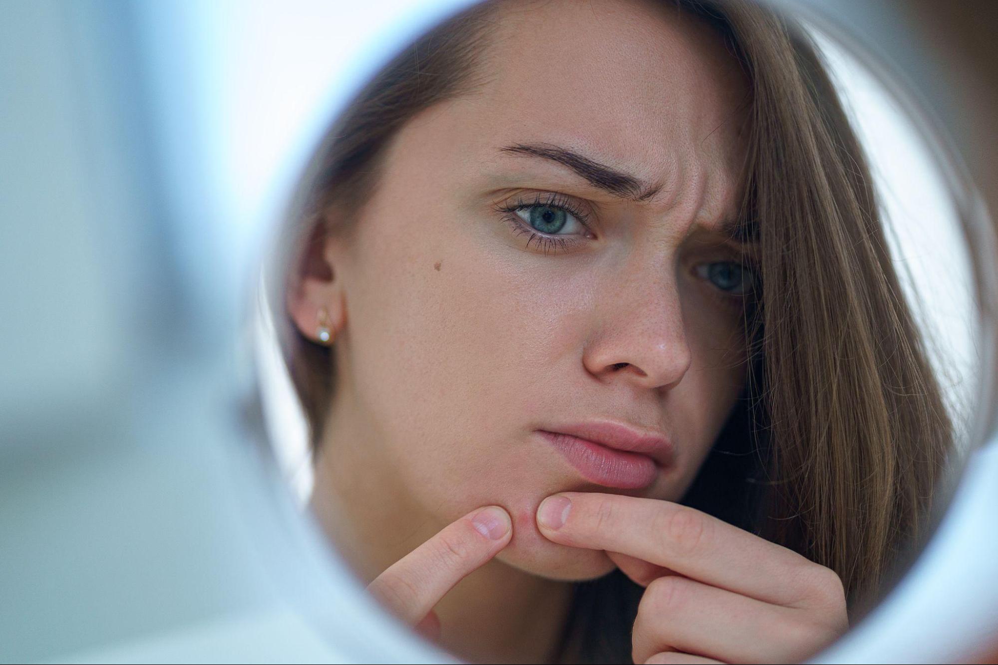 This is How to Naturally Remove Acne Scars, No Need to Visit a Beauty Doctor